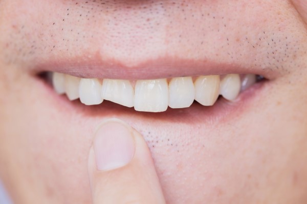 How A Chipped Tooth Can Lead To A Serious Problem