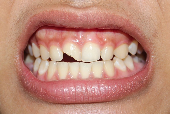 Treatment Options For A Chipped Tooth By A Cosmetic Dentist