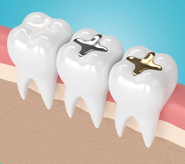 New Albany Composite Fillings
