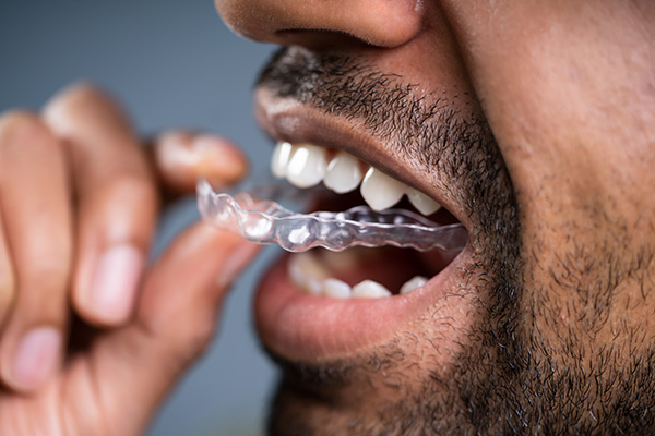 A Cosmetic Dentist Explains Benefits of Clear Aligners from River Falls Family Dental in New Albany, IN