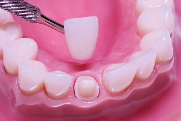 Quick Guide To Dental Crown Placement