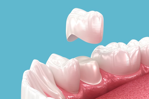 Dental Crowns: Their Purpose, Process, And Longevity