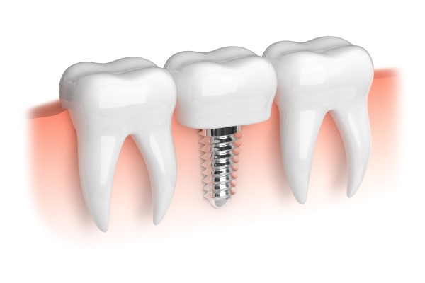 Dental Implant Restoration New Albany, IN