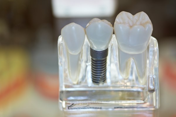 Dental Implant Restoration: How An Artificial Root Fuses To The Jawbone