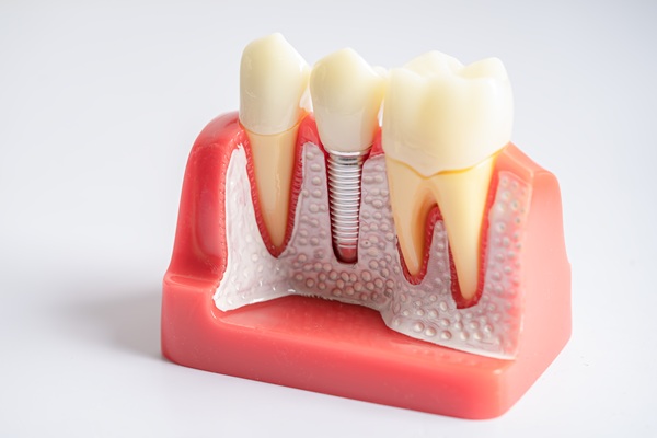Proper Dental Implant Care In Your Oral Hygiene Routine