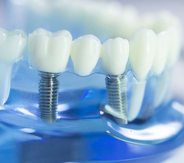 New Albany Dental Implants