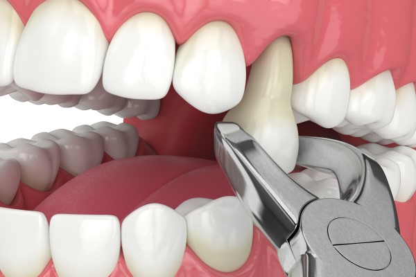 When A Dental Emergency Requires A Tooth Extraction