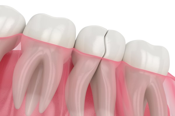 How To Find A Dentist For Tooth Replacement