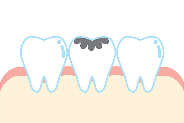 Dental Practice FAQs: How Are Cavities Treated? from River Falls Family Dental in New Albany, IN