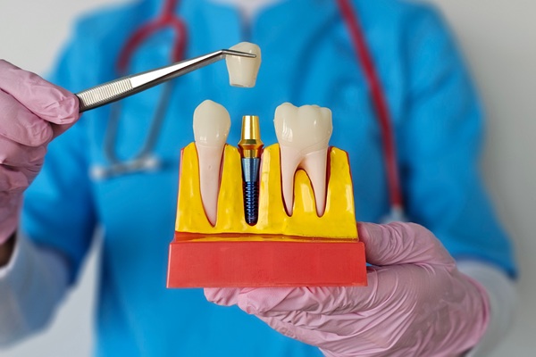 Implant Crowns: A Durable And Natural Looking Solution For Tooth Restoration