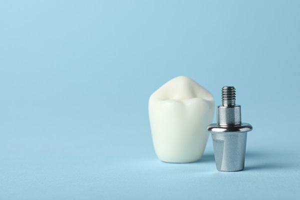 Dental Implant Restoration: Prosthetic Root And Crown