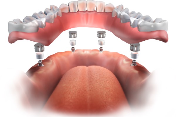 When Are Implant Supported Dentures An Option?
