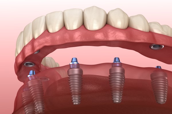 Implant Supported Dentures New Albany, IN