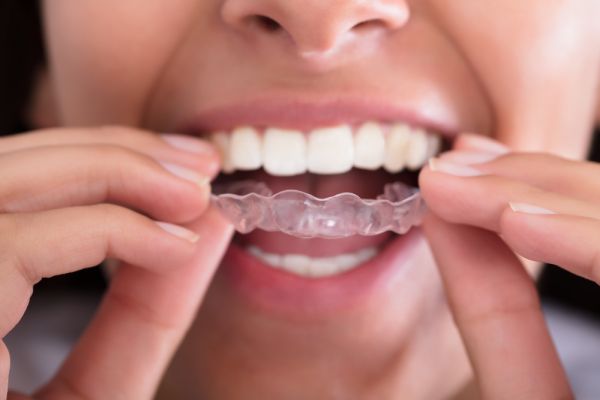 When Is A Night Guard For Teeth Grinding Recommended?