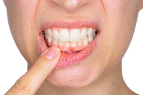 What To Expect When Treating Periodontal Disease