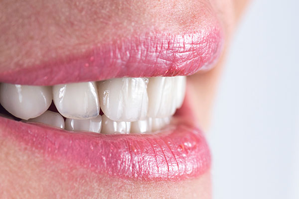 How To Prevent Cavities Under Veneers from River Falls Family Dental in New Albany, IN