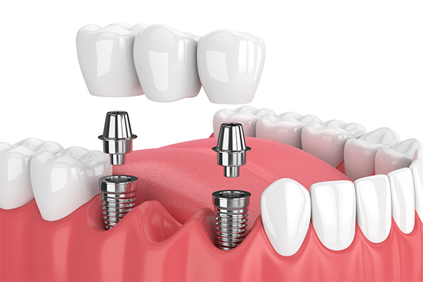 Options For Replacing Missing Teeth: Are Dental Bridges Right For Me?