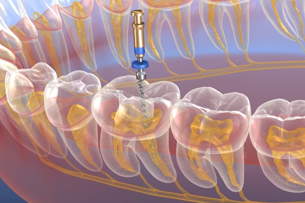 Root Canal Treatment New Albany, IN