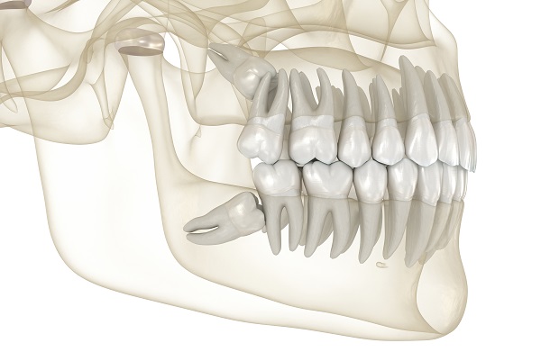 When To Have Wisdom Tooth Removal